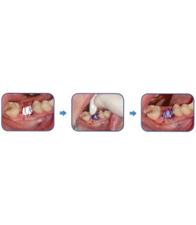 KIT PERIACRYL 10 MONODOSIS