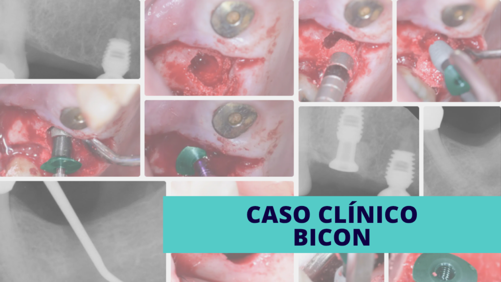 Este caso muestra el uso de pilares temporales crestales de perfil delgado con un eje alto durante la colocación de implantes cortos Bicon SHORT®. Se realizó un procedimiento de elevación sinusal interna en un segundo molar superior izquierdo, así como en un primer molar mandibular izquierdo, con una ausencia ósea significativa.