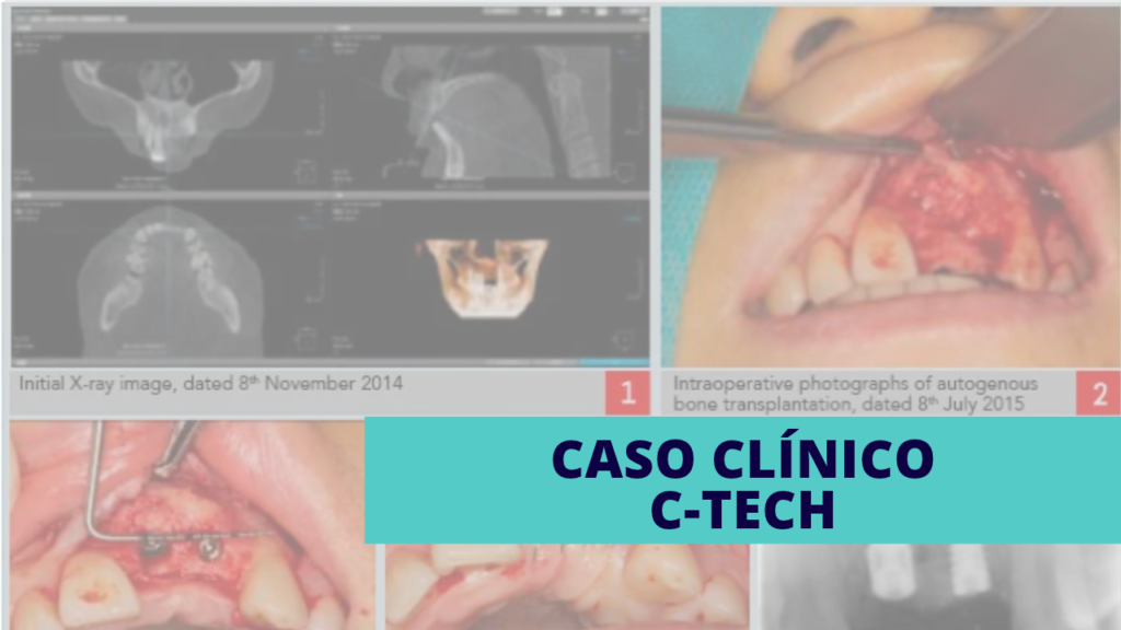 Caso clínico de rehabilitación de los dientes 21 y 22 mediante implantes C-Tech, incluyendo un implante Narrow en el maxilar superior. El seguimiento a 8 años muestra una osteointegración estable, buen mantenimiento de los tejidos periimplantarios y conservación de la función y la estética.