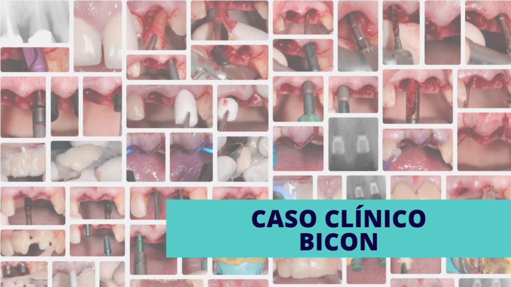 Caso clínico de rehabilitación con dos implantes cortos Bicon de 5 x 6 mm, mostrando la secuencia desde la preparación de los sitios de extracción con tapón de colágeno reabsorbible hasta la colocación de los implantes, la provisionalización y la restauración definitiva con coronas de pilar integrado Bicon™.
