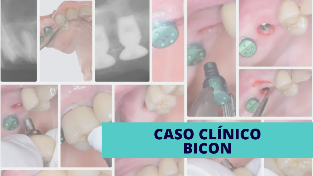 Uso de pilares temporales escaneables Bicon con protocolo de implantes en una sola fase, optimizando el flujo de trabajo, reduciendo el tiempo en clínica y permitiendo fabricar la prótesis definitiva durante la integración del implante.